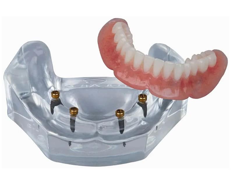 Permanent dentures implants
